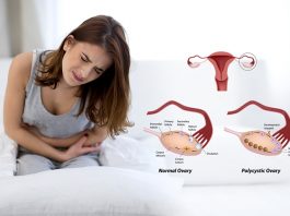 Polycystic ovary syndrome