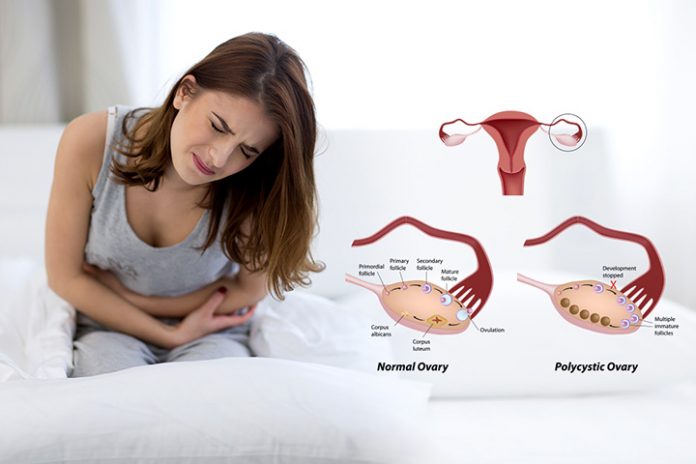 Polycystic ovary syndrome