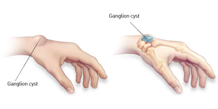 Damages of the Ganglion cyst in the Hand