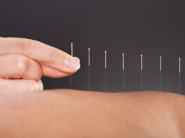 Acupuncture